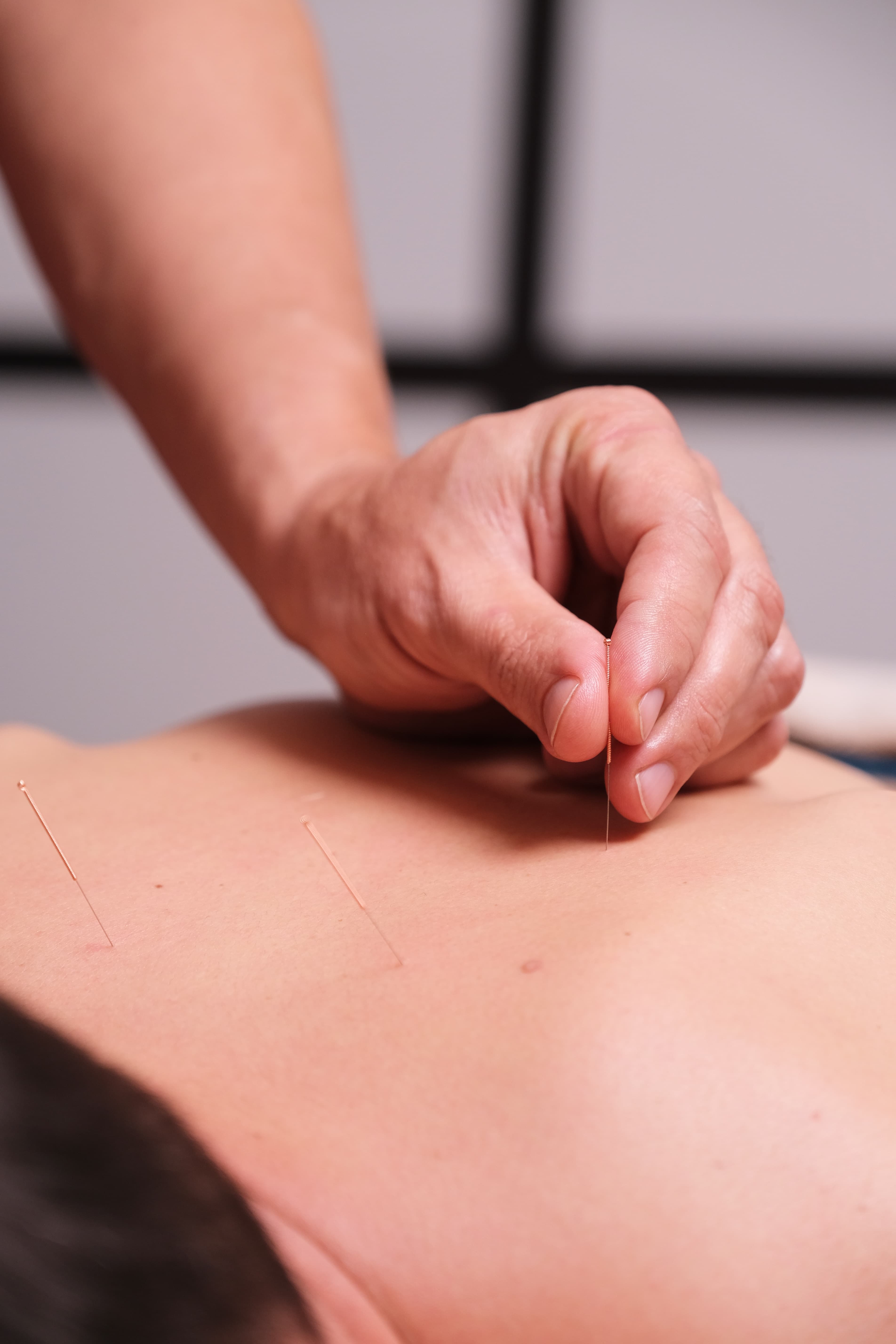 Acupunctura — 3