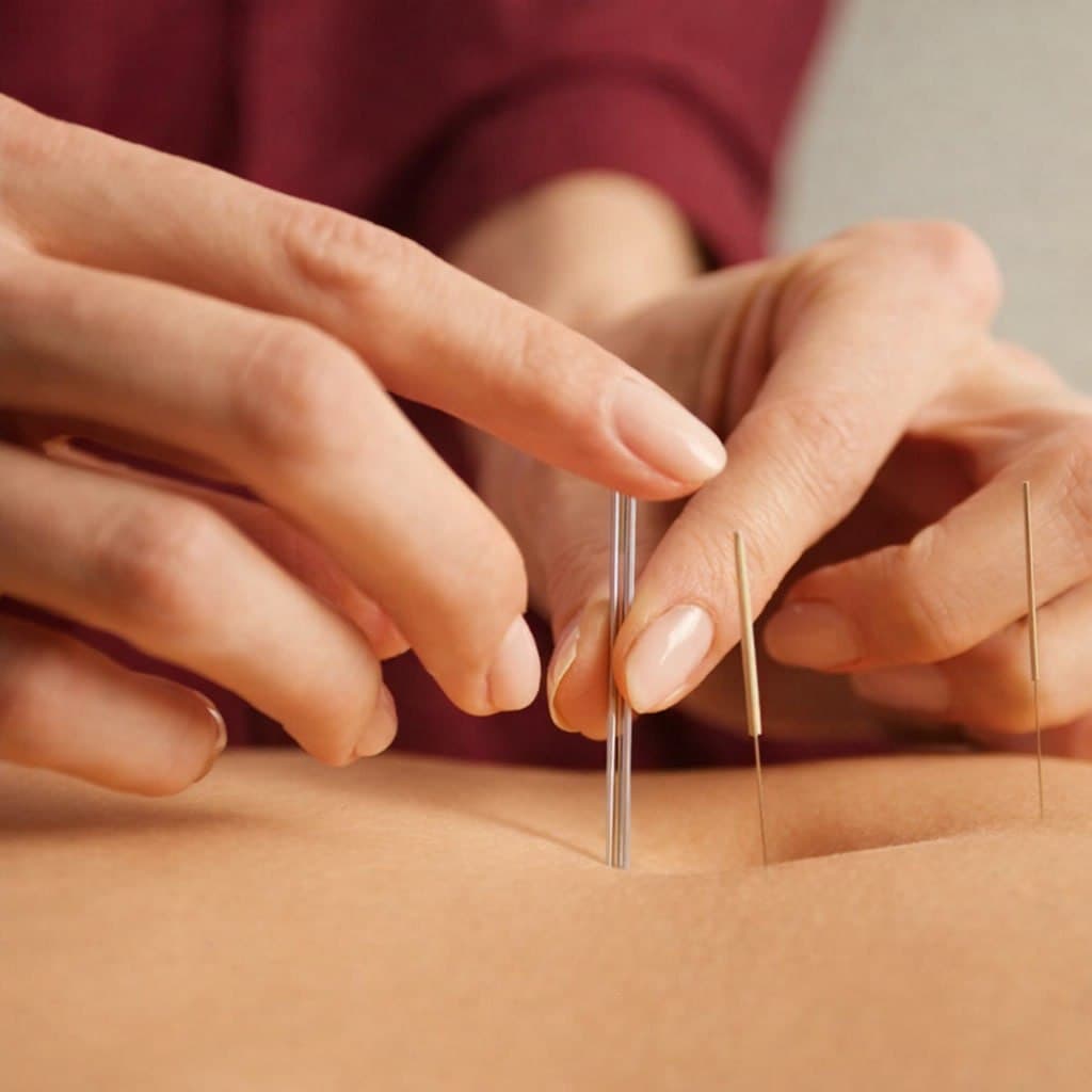 Acupunctura